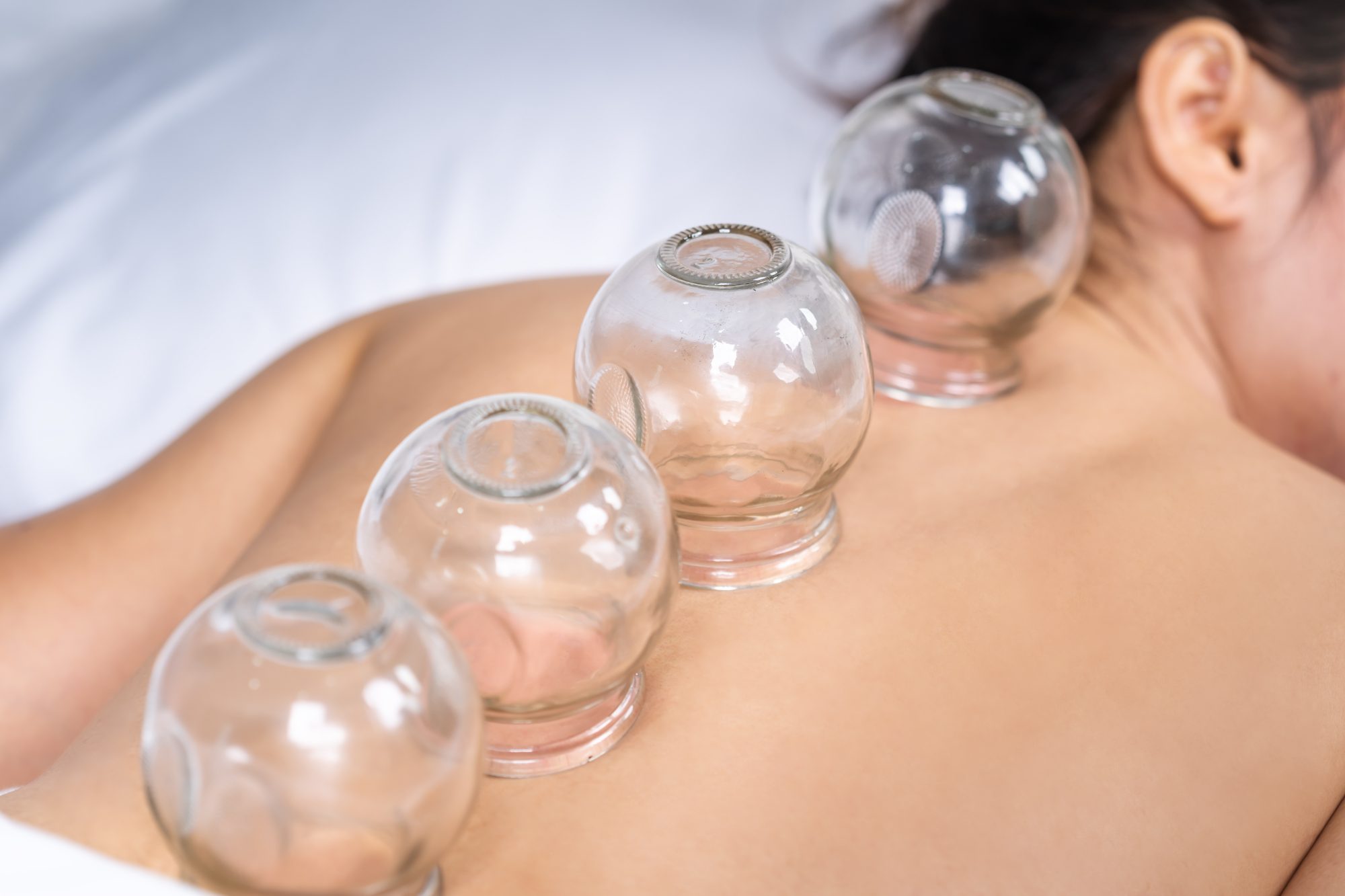 Cupping therapy treatment being applied to patient's back with glass cups
